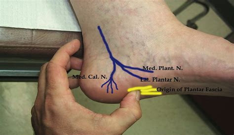 heel compression test|nerve entrapment heel surgery.